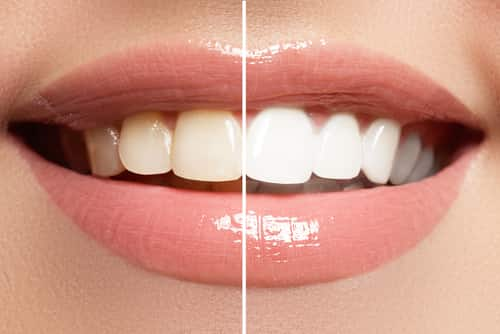 teeth whitening transformation