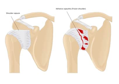 Frozen shoulder