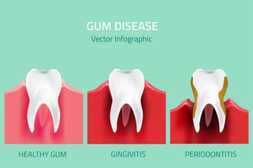 Gum disease