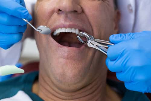 Tooth extraction