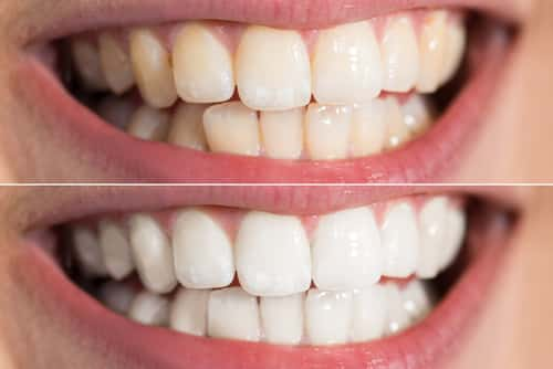 teeth whitening transformation