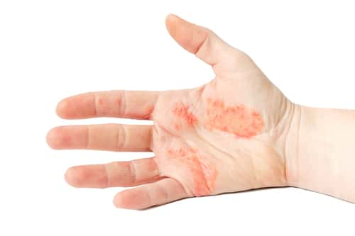 Eczema