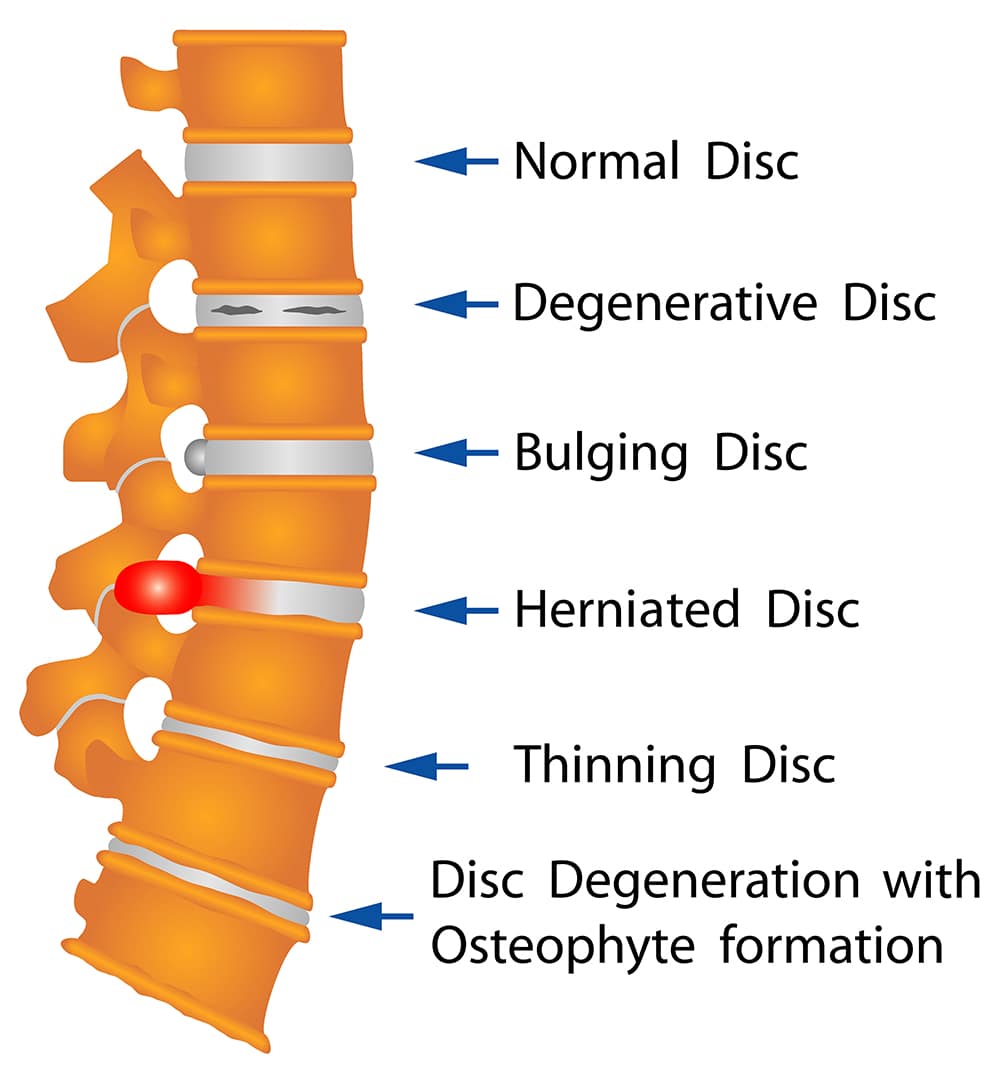 spine conditions singapore