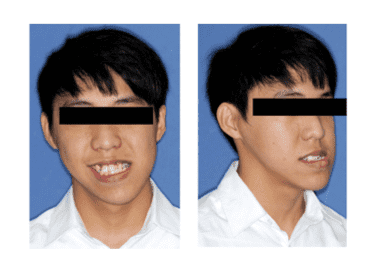 long lower jaw for jaw surgery