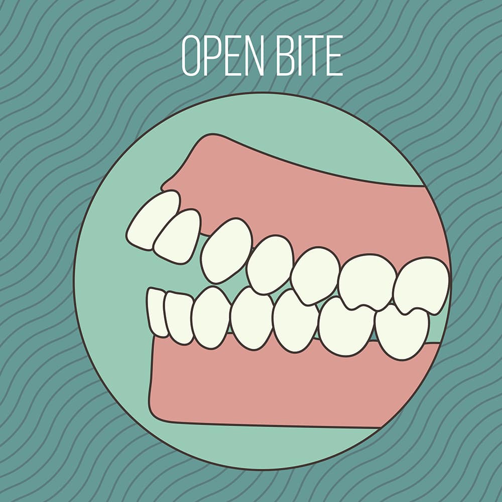 open bite national dental centre singapore