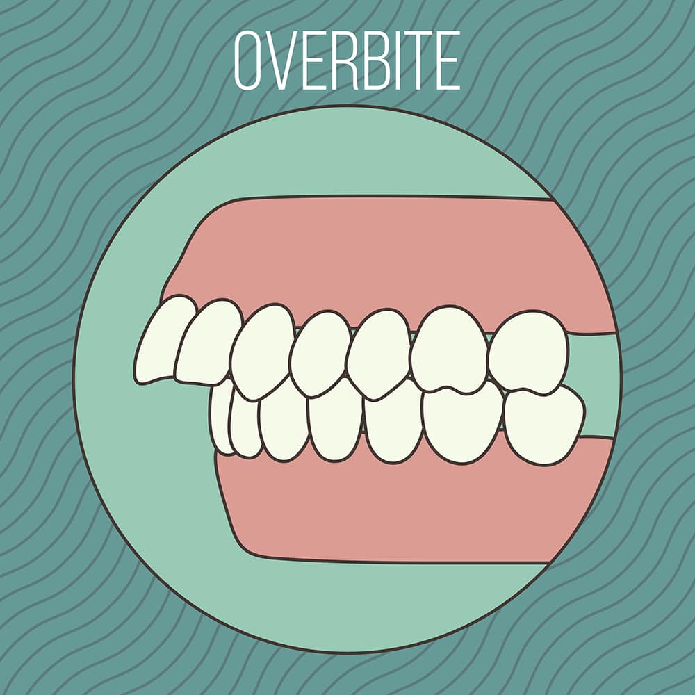 overbite 