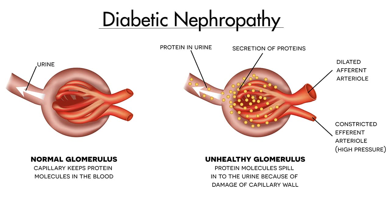 Diabetic nephropathy 