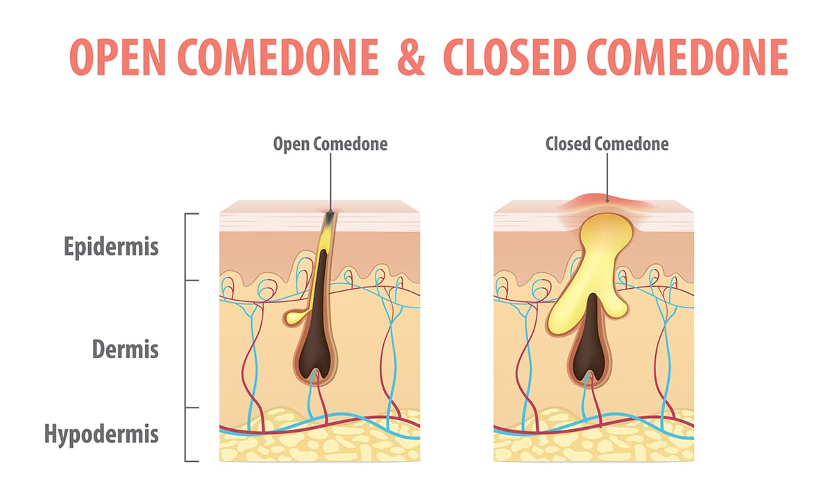 open and closed comedones