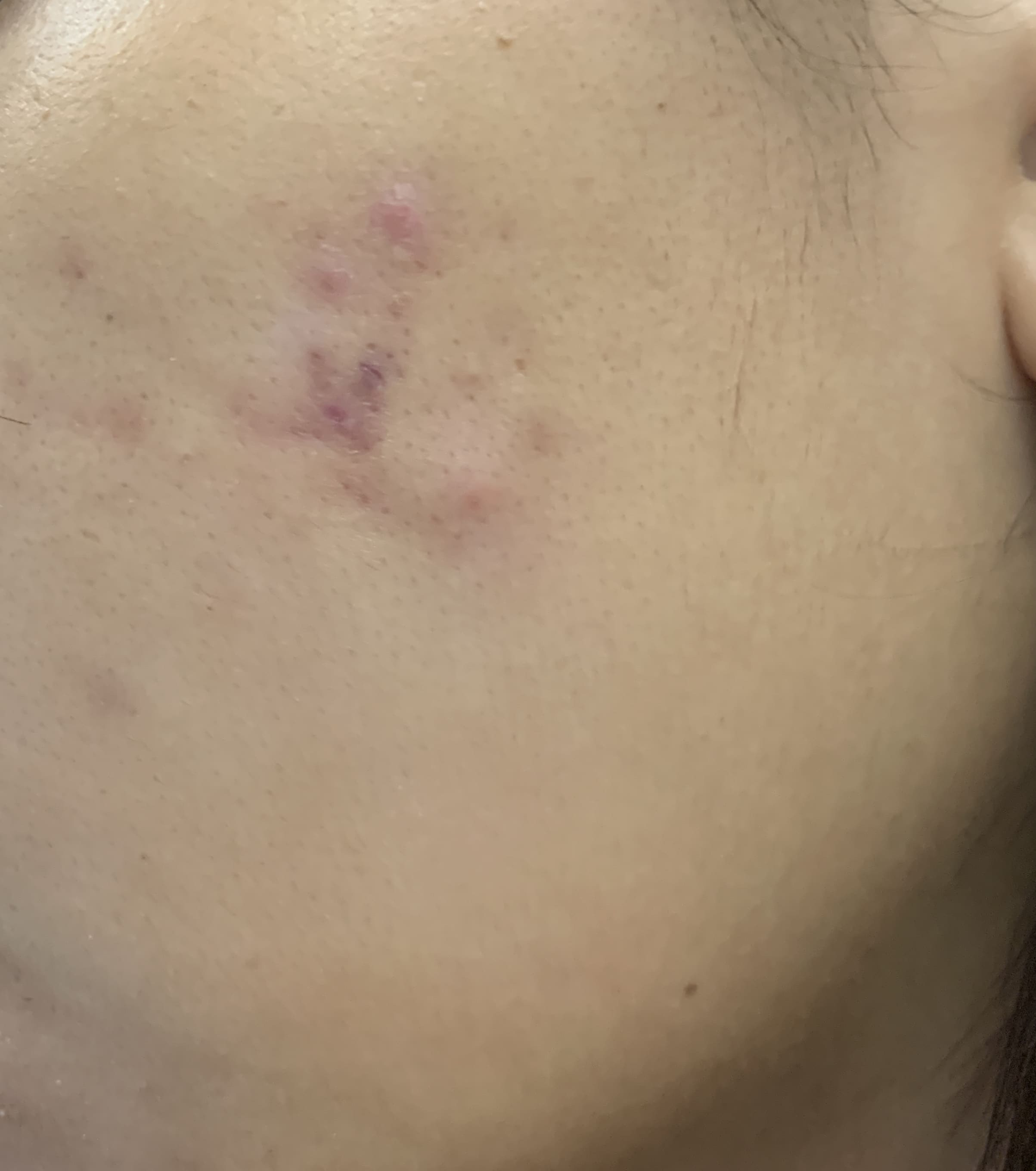 How Do I Get Rid Of Red Acne Scars Due To Active Outbreaks Photo Human