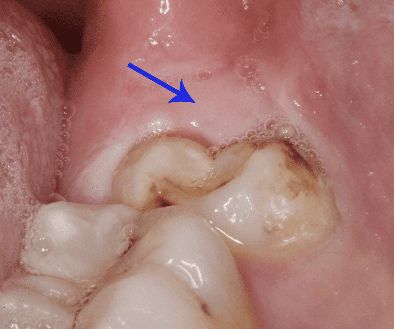 Gum swollen wisdom tooth