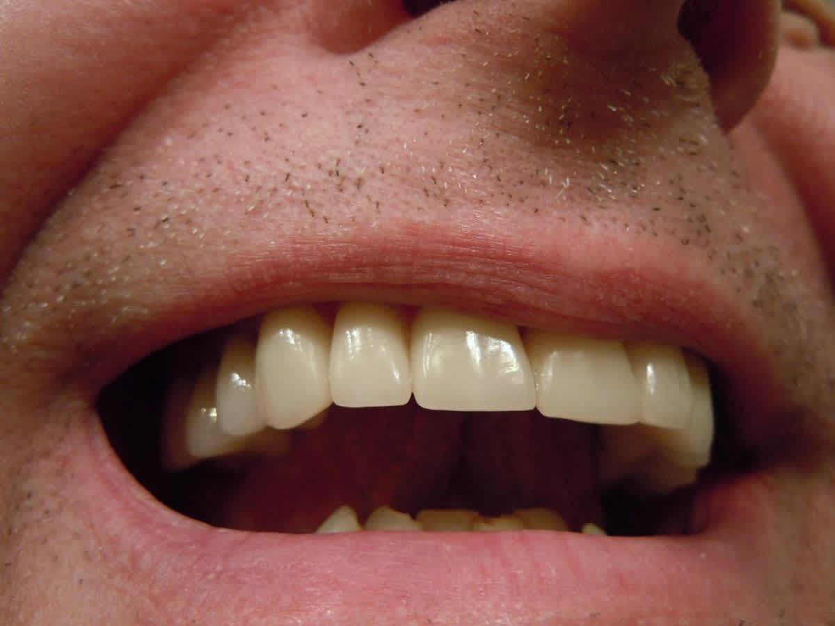 man's teeth smiling