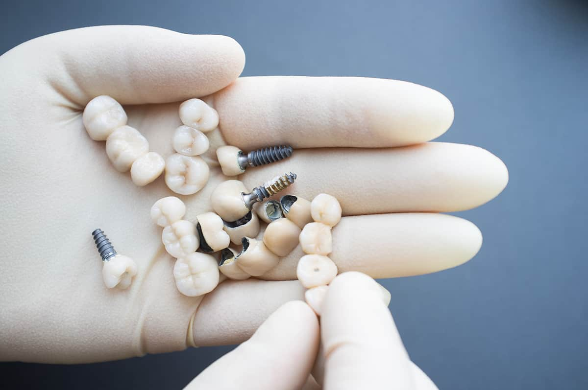 dental crowns in a gloved hand