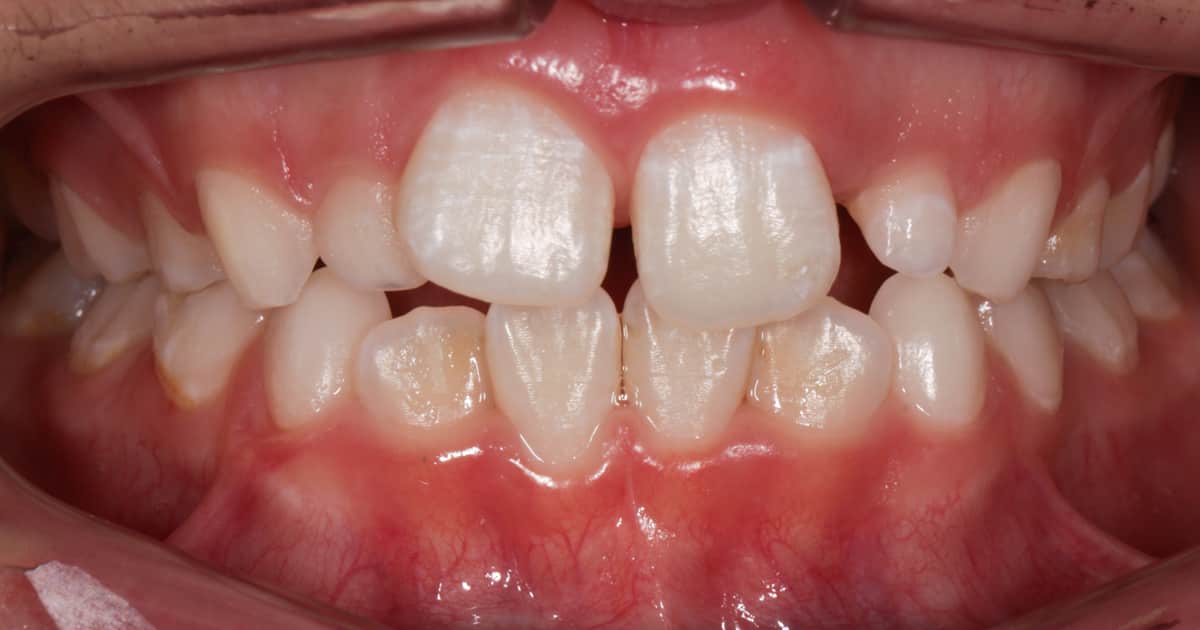 a child's teeth closeup