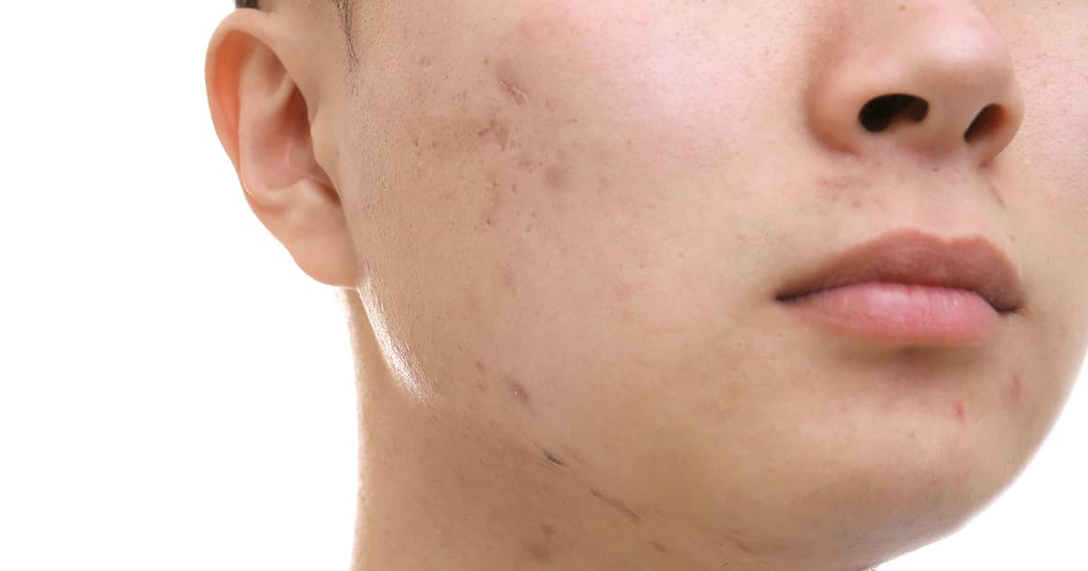 lower face of a person with acne