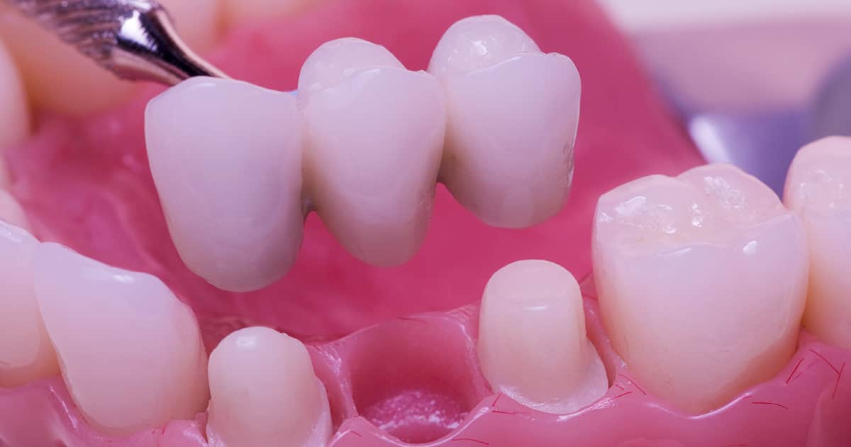 dental bridge replacing one tooth