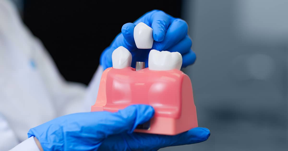 model of a dental implant