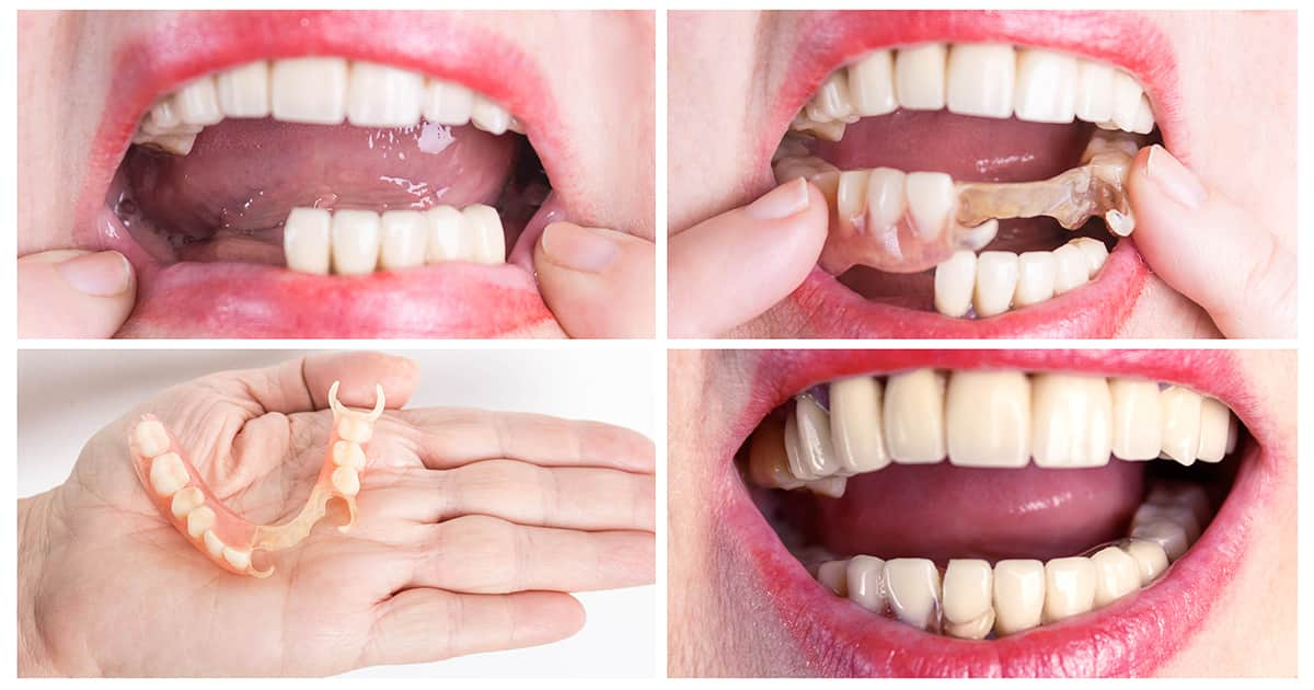 process of placing dentures