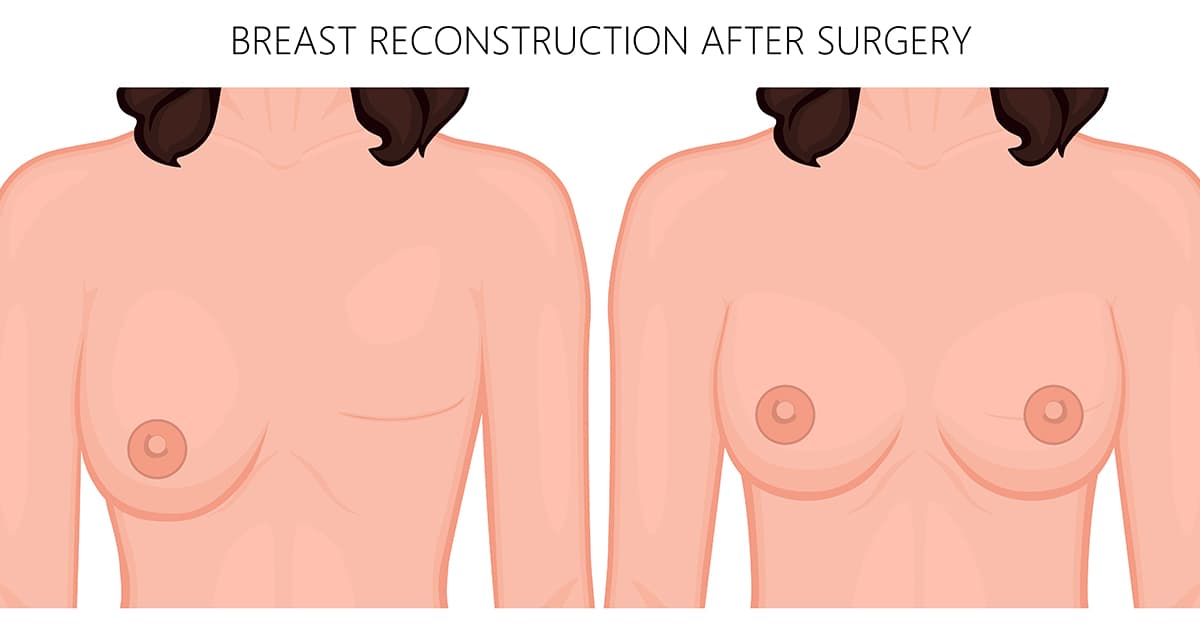 illustration of a breast reconstruction procedure