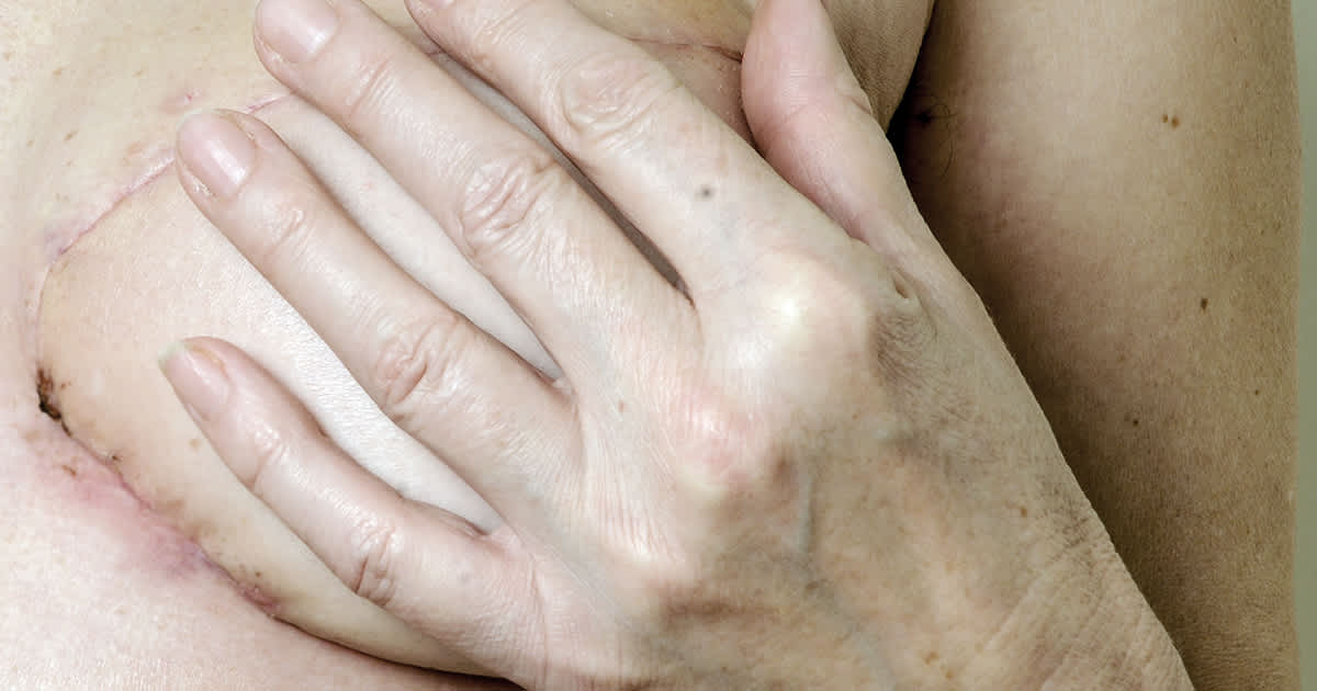 woman covering her breast with a surgical scar