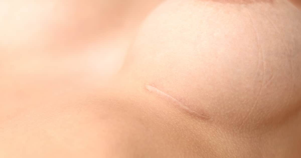 a breast scar under the breast that is healing