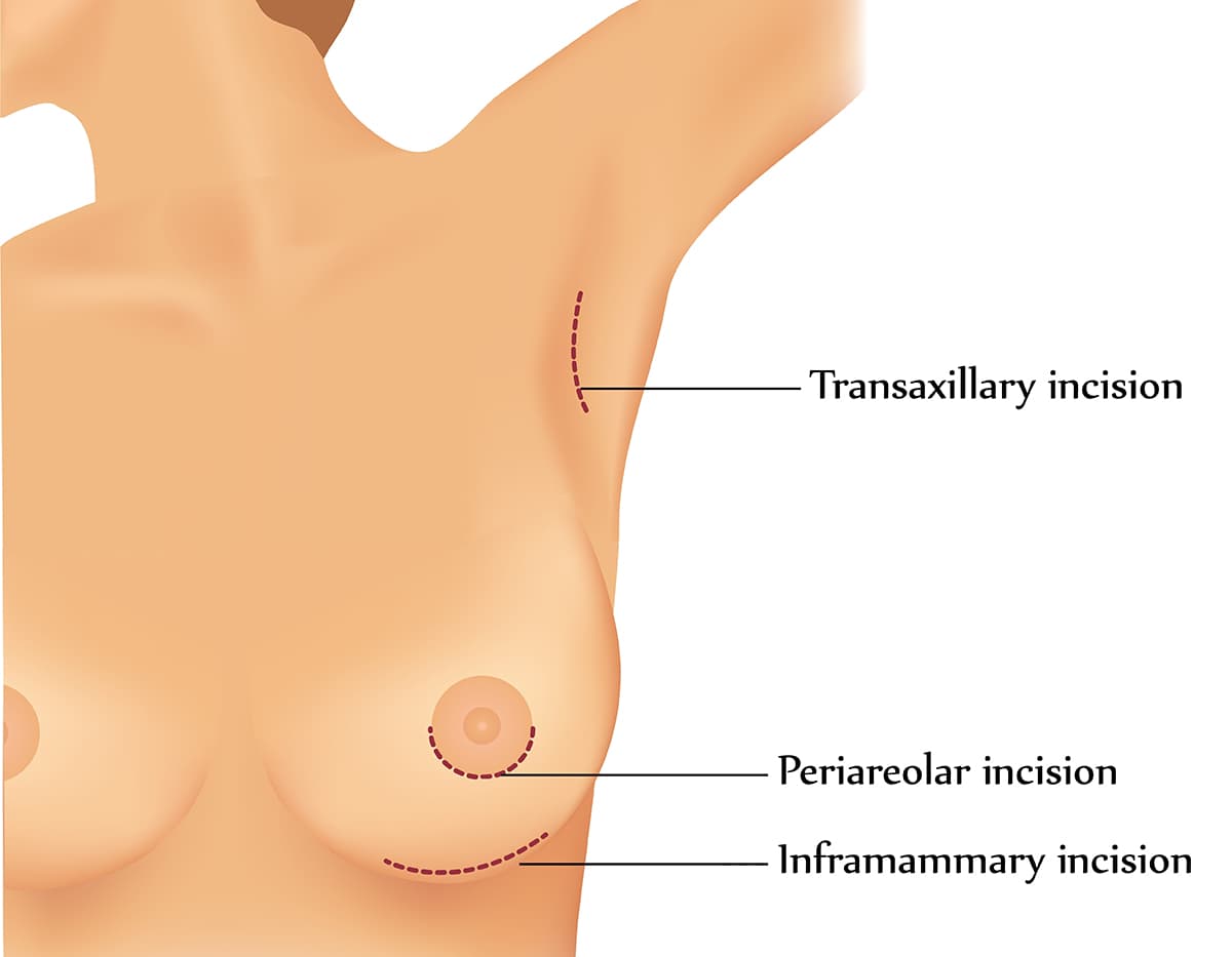 illustration of possible breast surgery incision sites