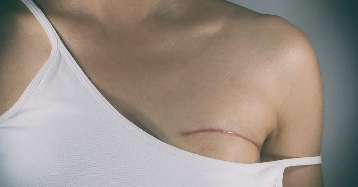 a woman with a surgical scar on her breast