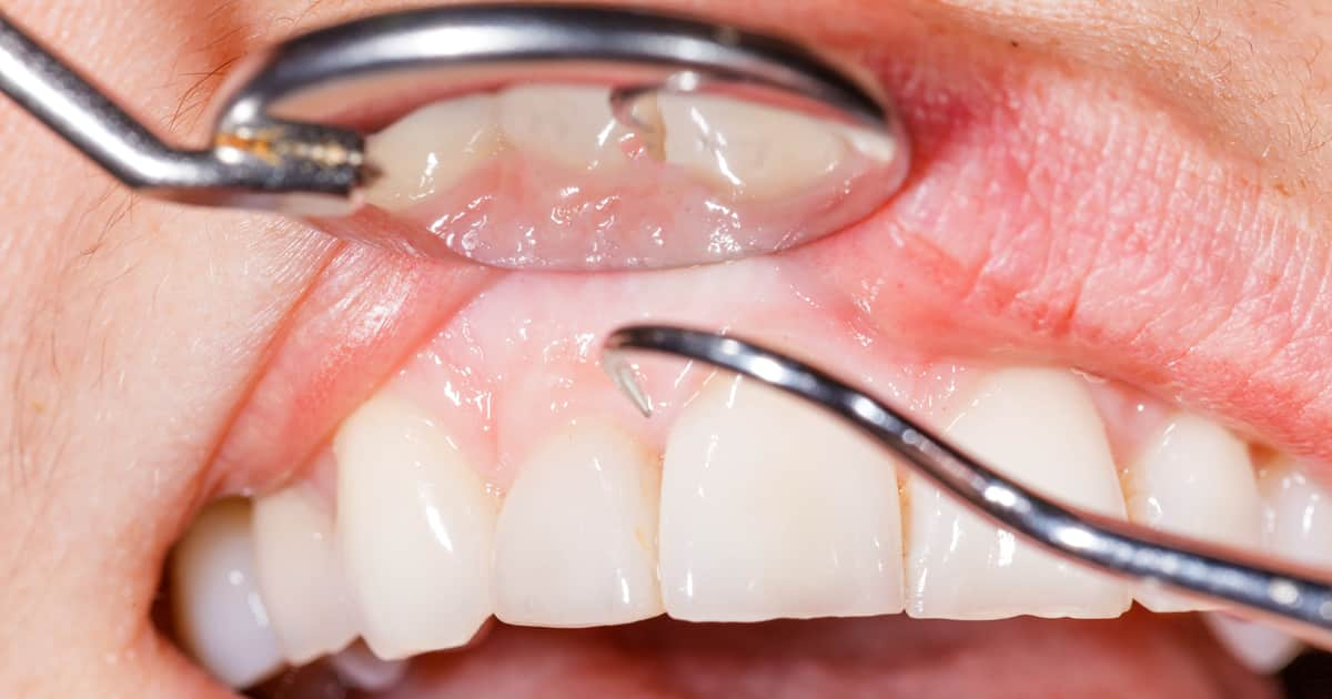 closeup of gums being treated by a dentist