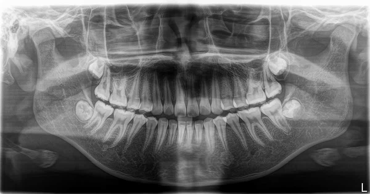 dental x ray