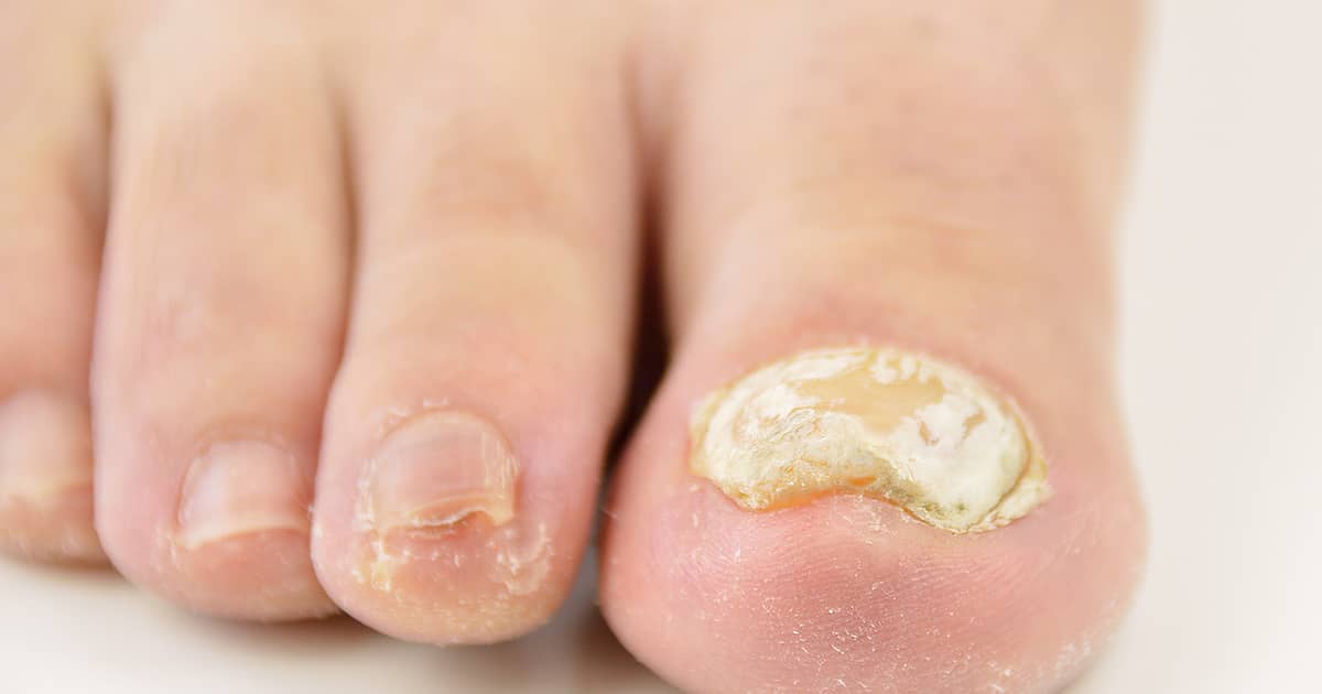 deformed toenail