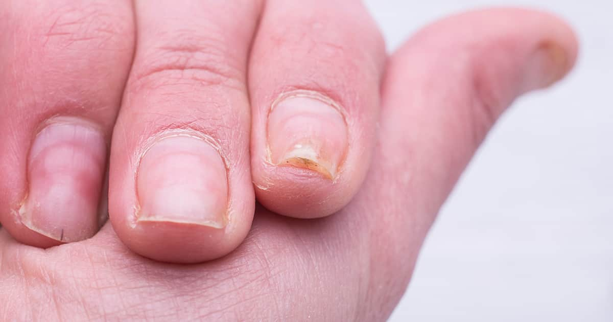 an infected fingernail