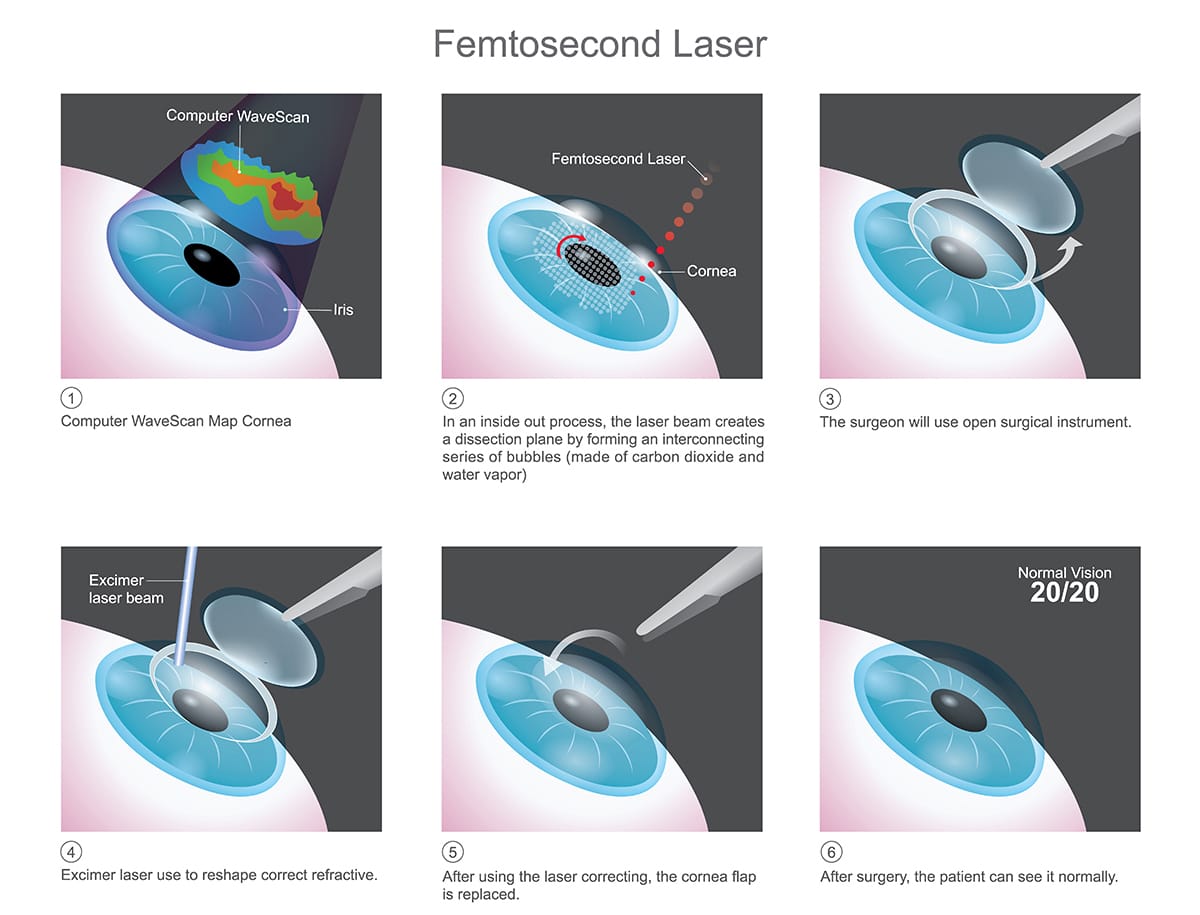 femtosecond laser surgery