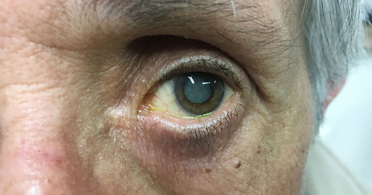 elderly person's eye with a cataract