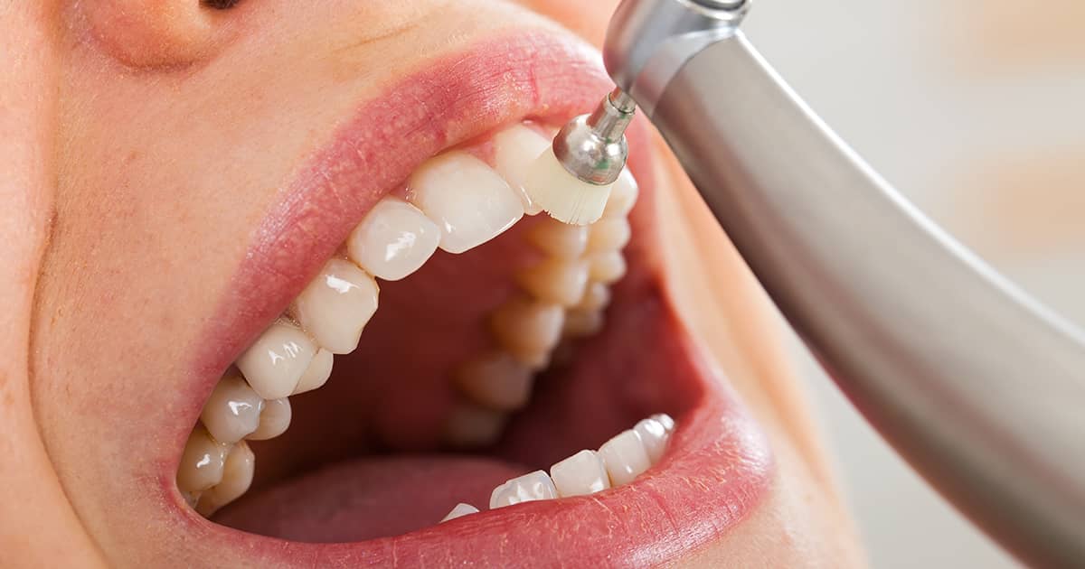 tooth polishing on a woman's teeth