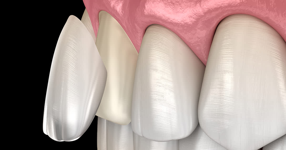 dental veneers