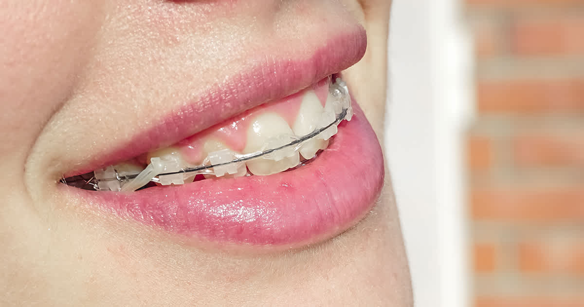 woman with braces