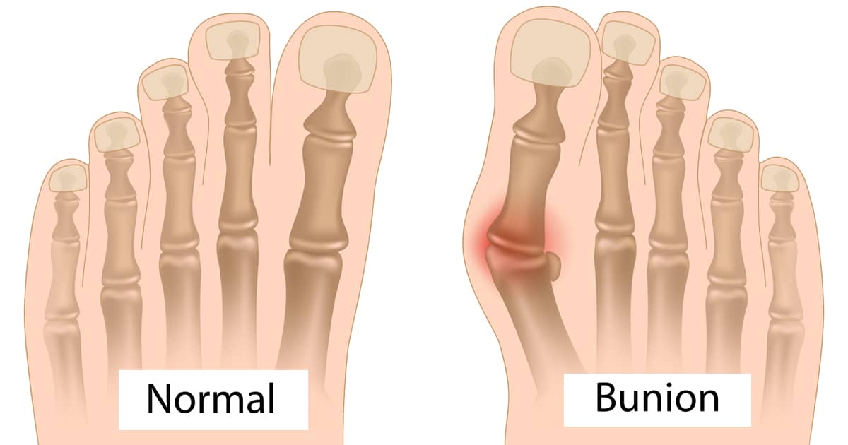 normal foot versus a foot with a bunion