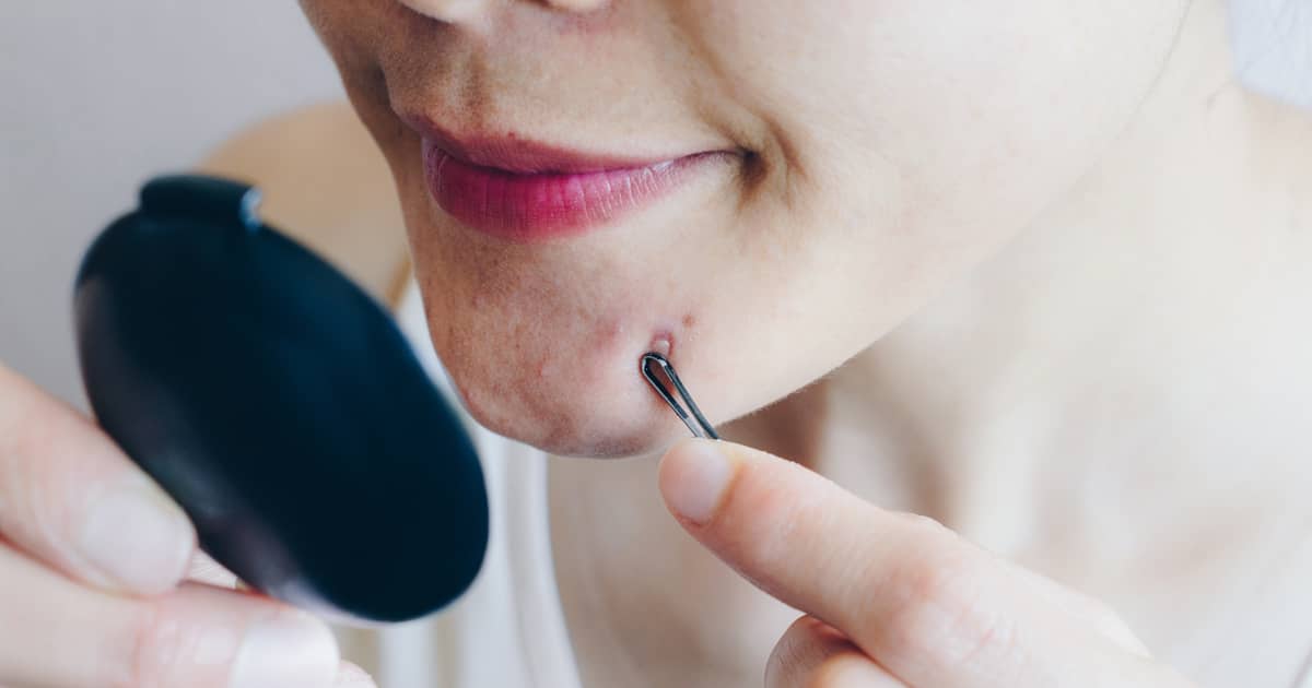 woman extracting pimples with a tool