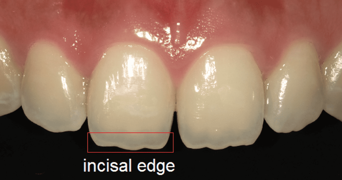 Why Are The Edges Of My Teeth Translucent