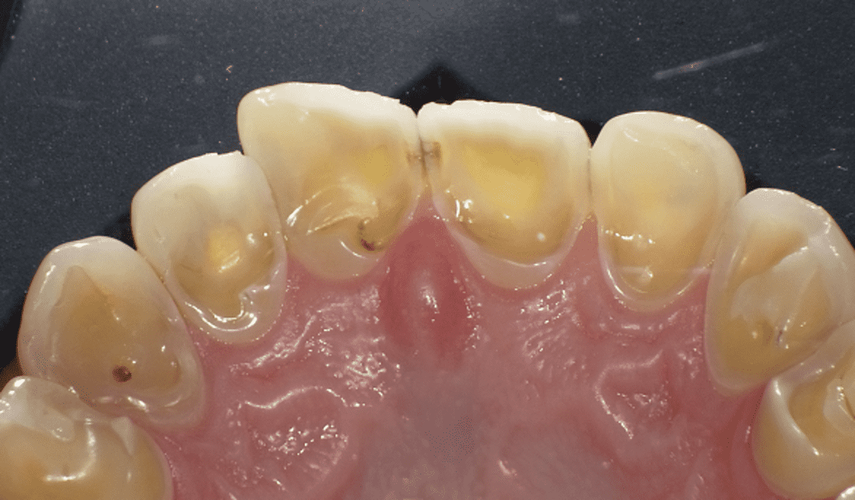 teeth are translucent