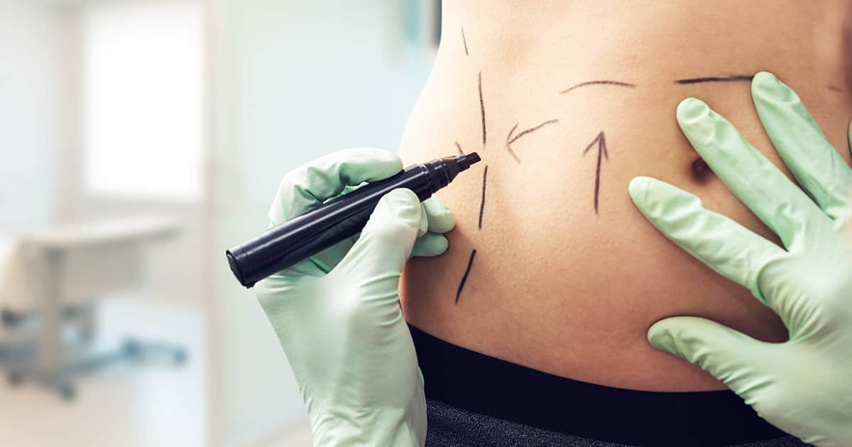 a plastic surgeon marking a woman's body with a pen