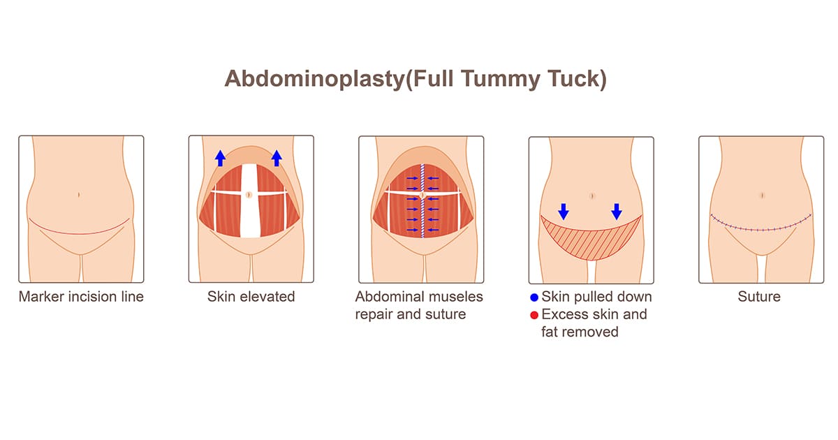 tummy tuck process diagram