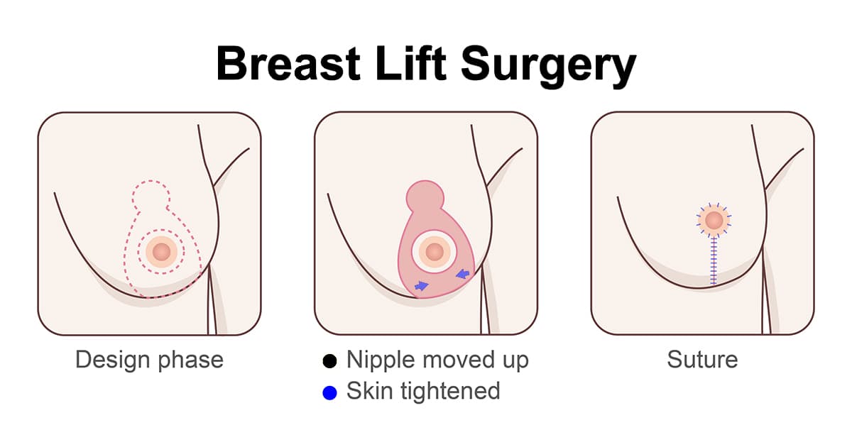 breast lift surgery illustration