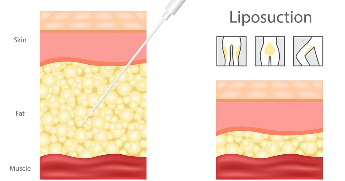 diagram showing liposuction using a cannula