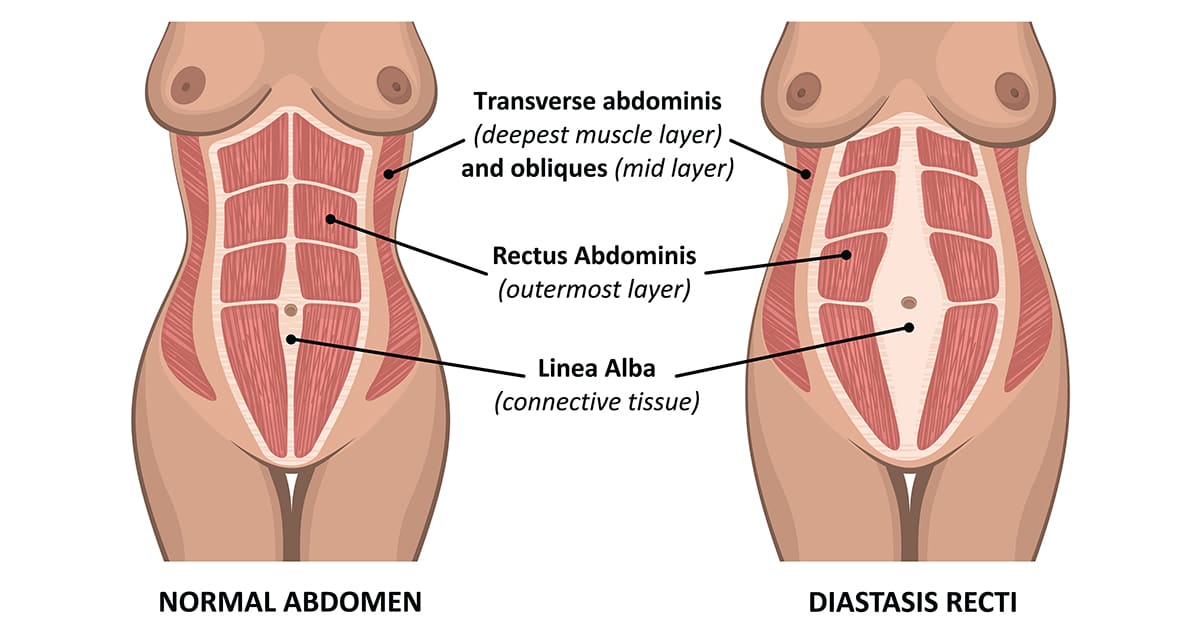 separation of abdominal muscles after pregnancy