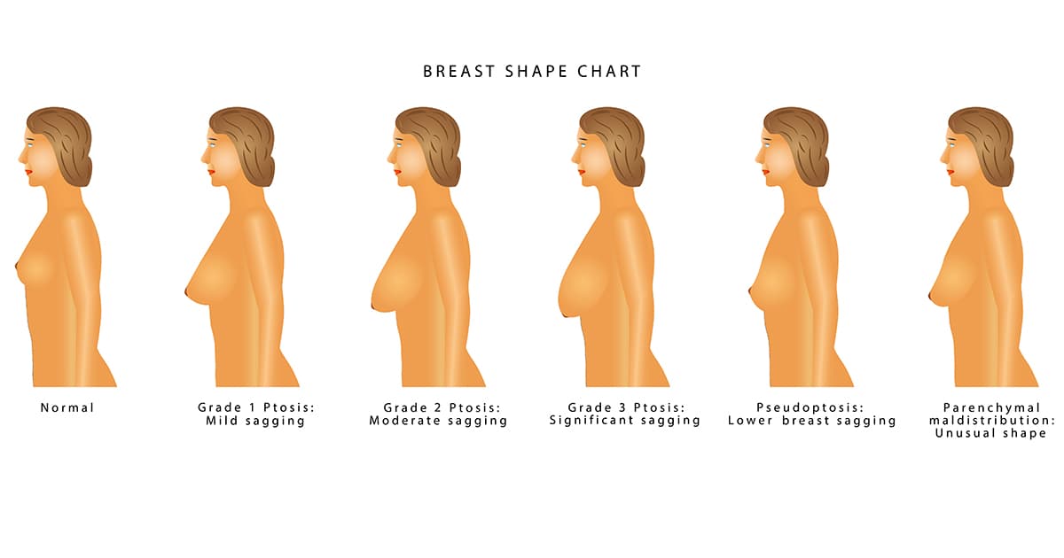 different types of breast sagging after pregnancy