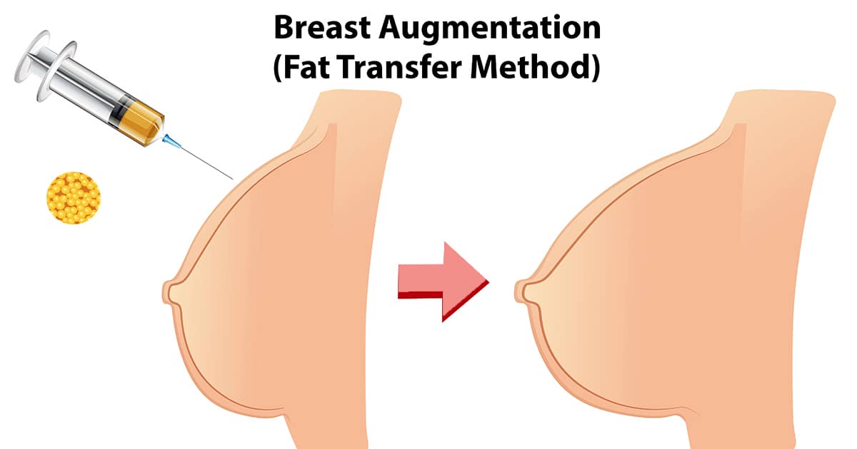 breast fat transfer