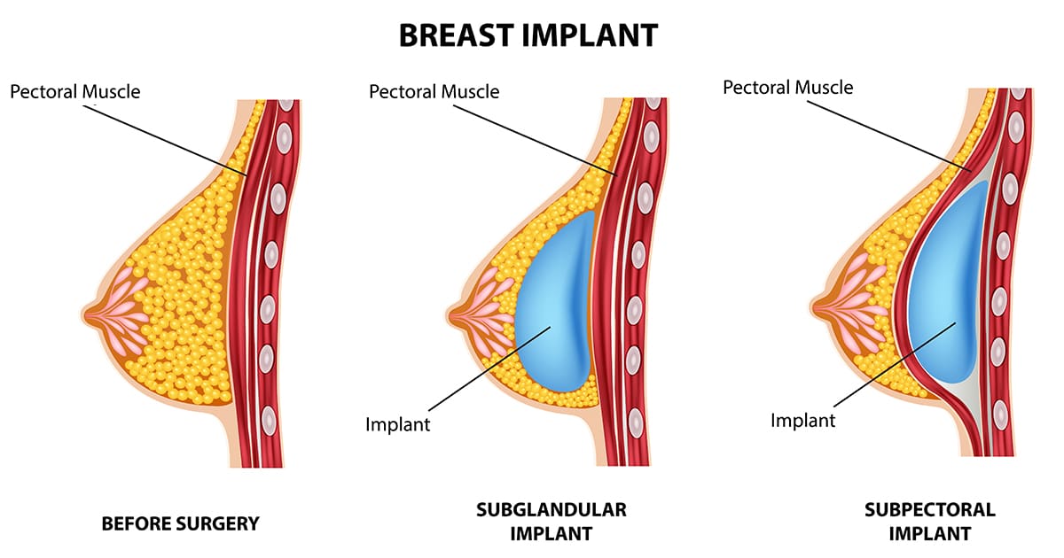 breast implant surgery