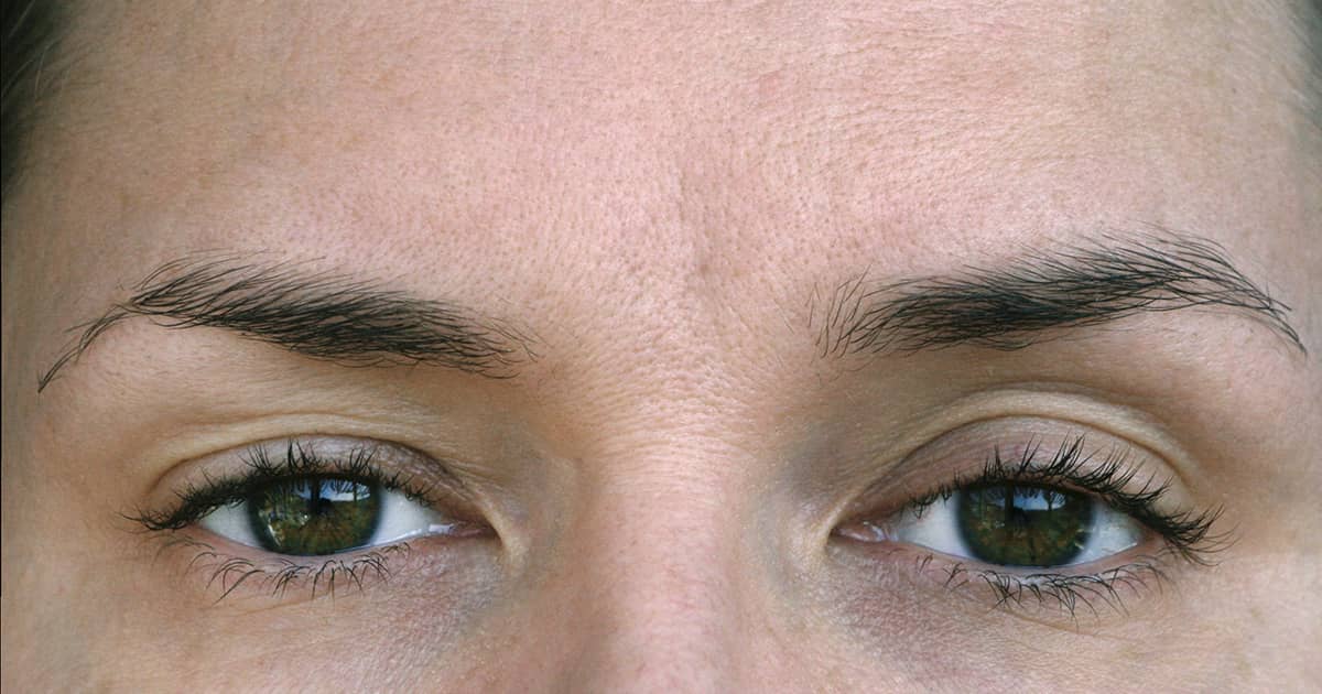 ptosis in the eyes of a woman