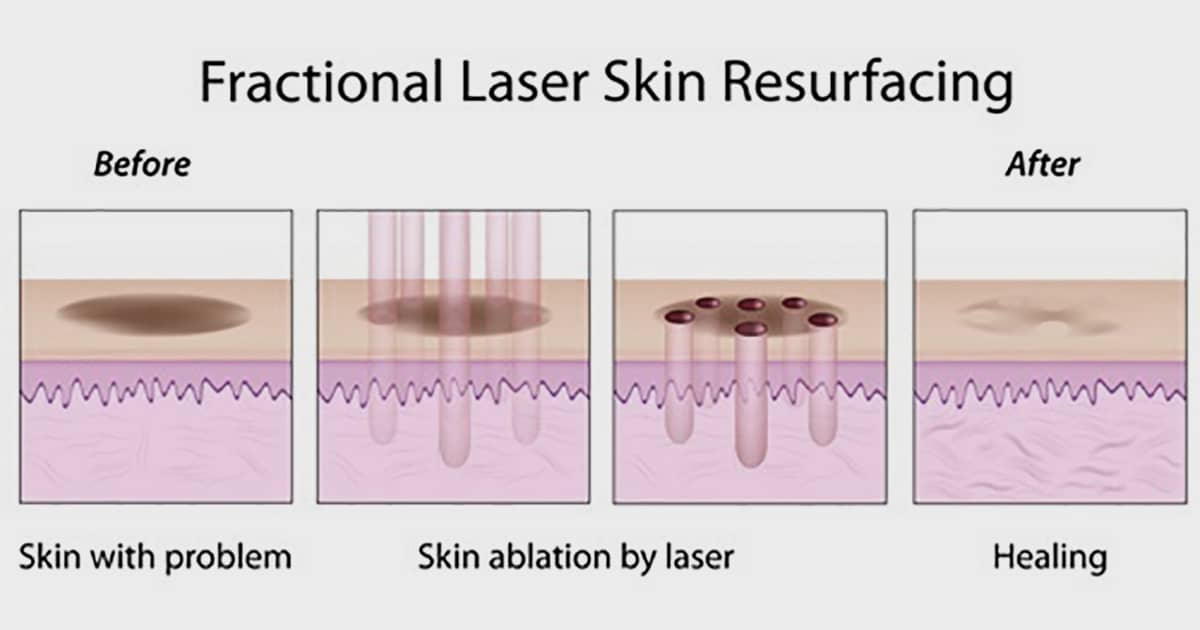 fractional laser treatment medical illustration