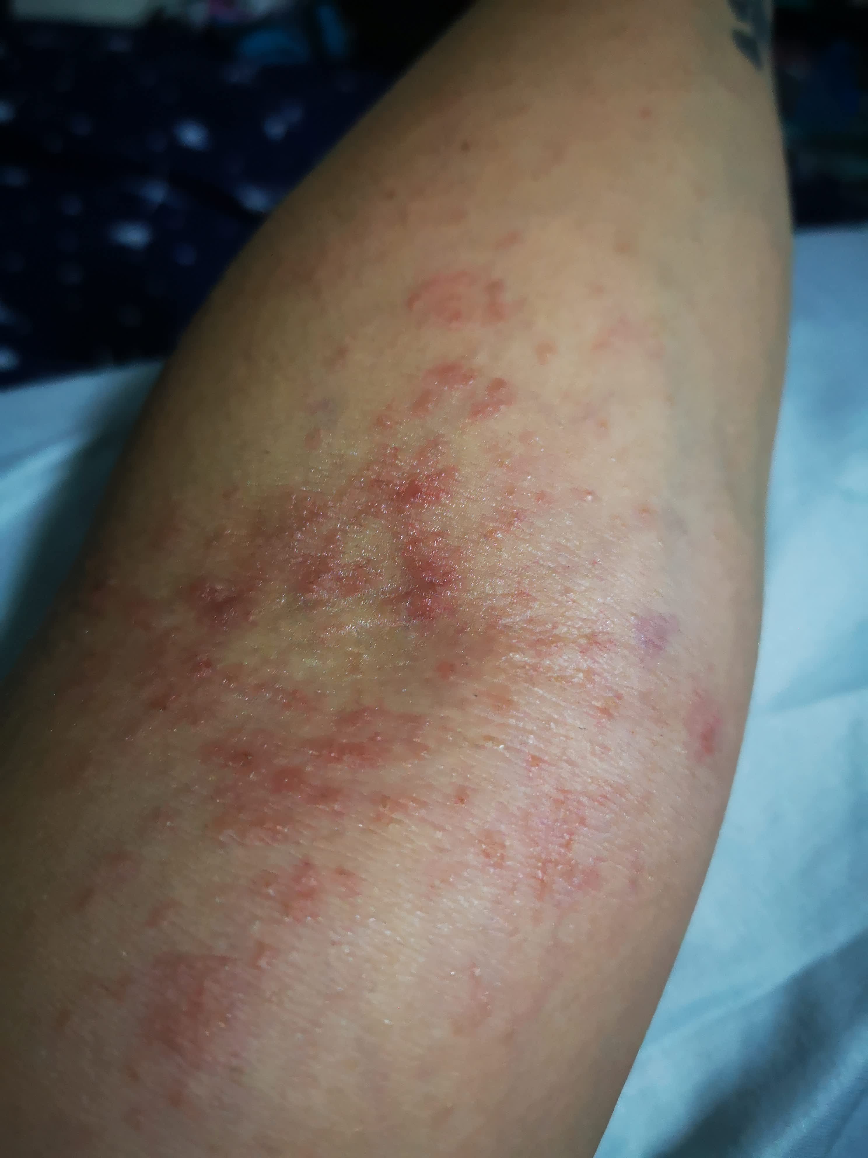 How do I differentiate between eczema and contact dermatitis (photo